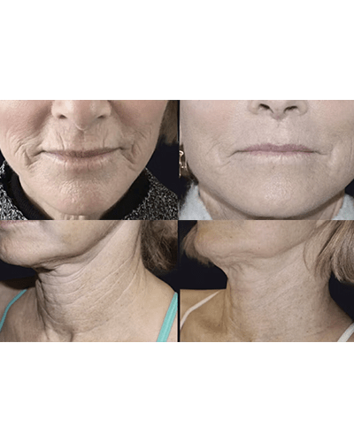 microneedling near me la beauty boutique north york midtown toronto