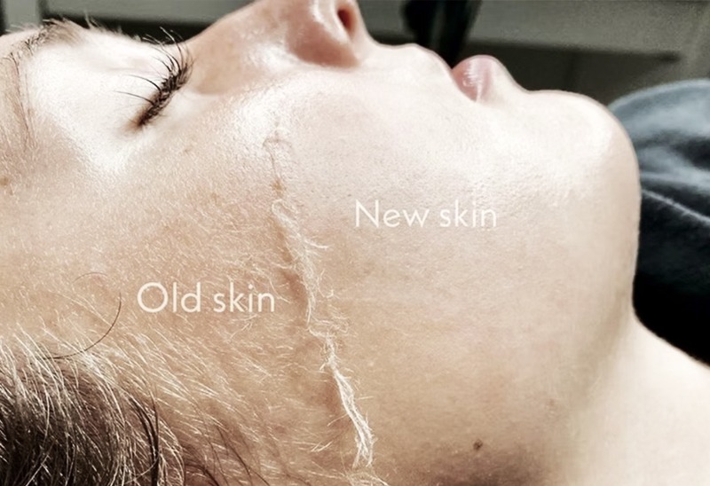 Face Waxing vs Dermaplaning: Which Is Better for Smooth Skin?