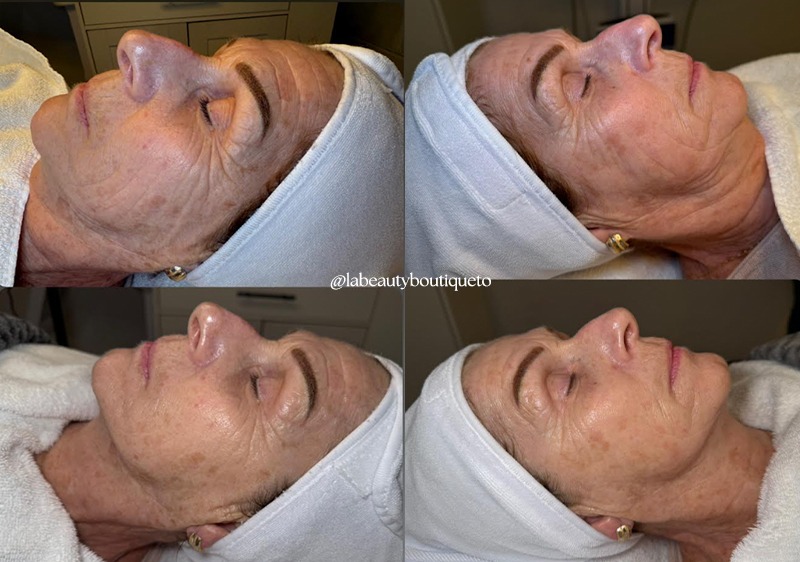 Aerolase Laser Chemical Peel Facial Combo Before and After La Beauty Boutique Toronto Midtown North York