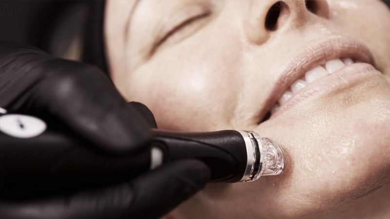 HydraFacial before event Toronto glowing skin treatment