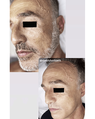 Aerolase near me midtown north york toronto la beauty boutique