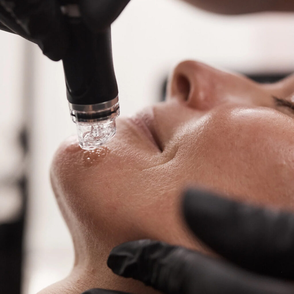 HydraFacial Vortex-Fusion wand during treatment at La Beauty Boutique Toronto