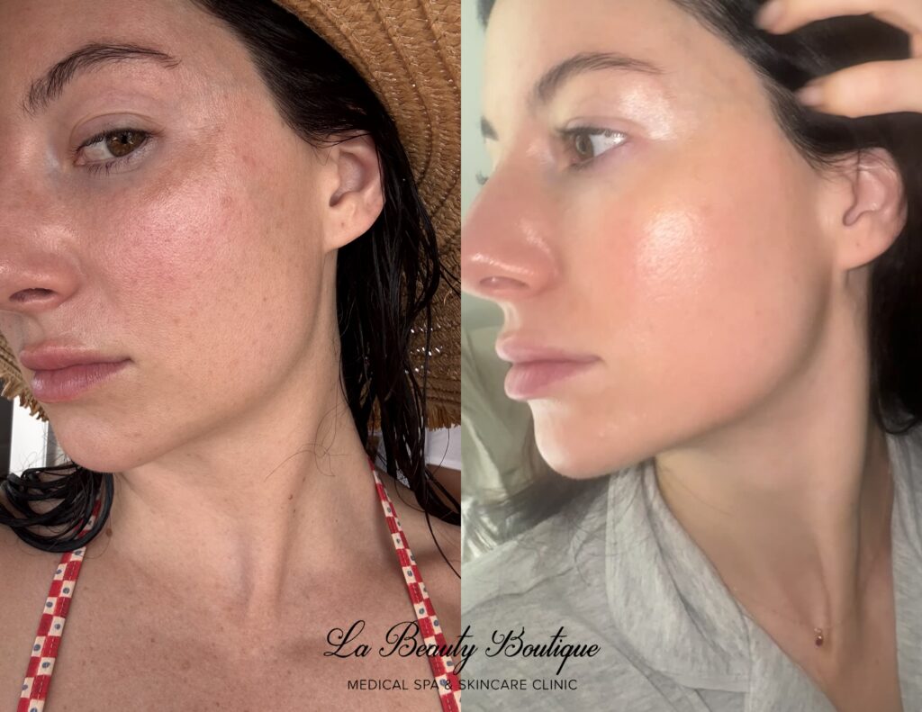 Microneedling before and after - real result at La Beauty Boutique Toronto, redness and texture visibly calmer after treatment