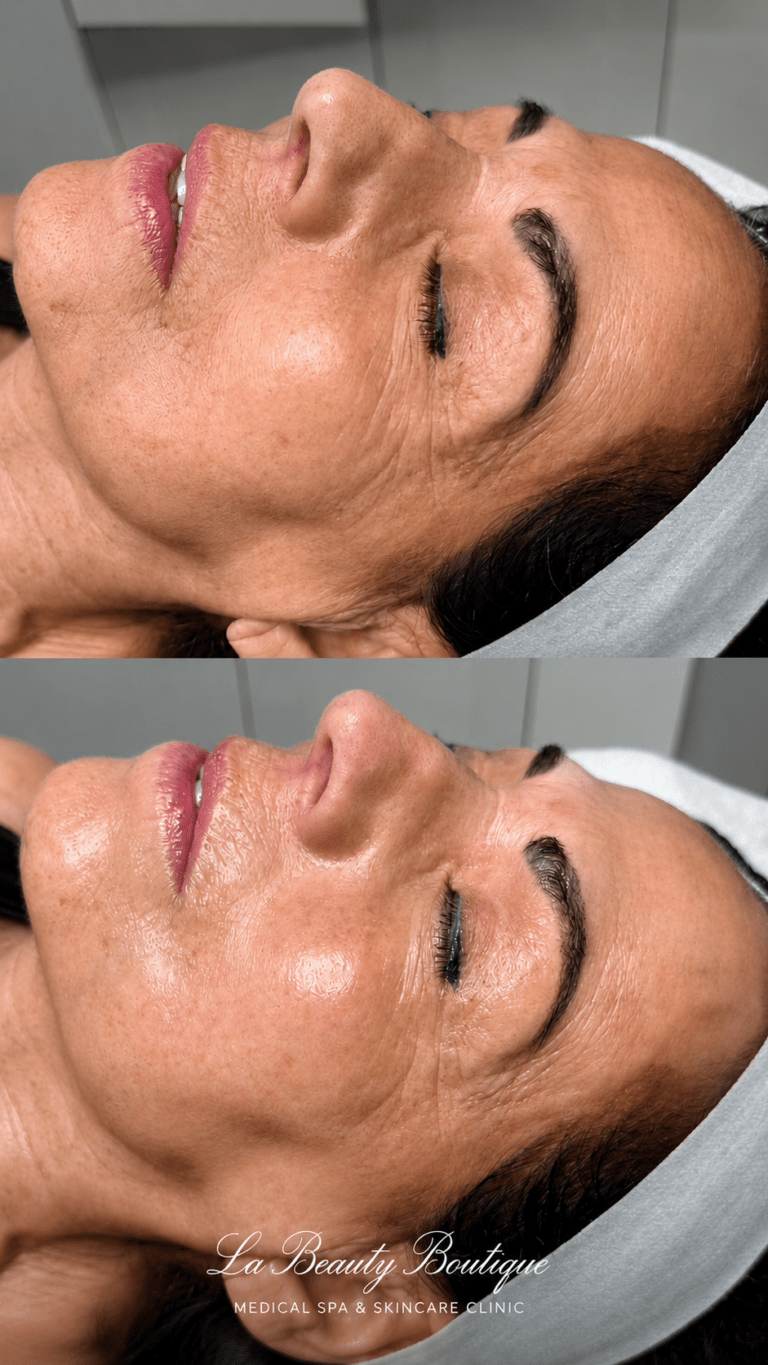 HydraFacial before and after - client skin before and immediately after one treatment at La Beauty Boutique Toronto